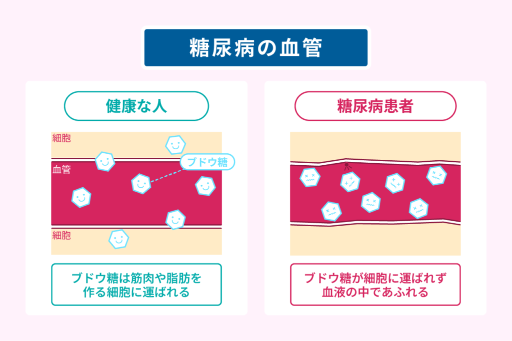 糖尿病の血管