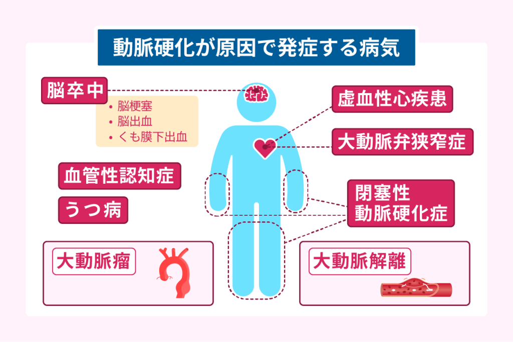 動脈硬化が原因で発症する病気