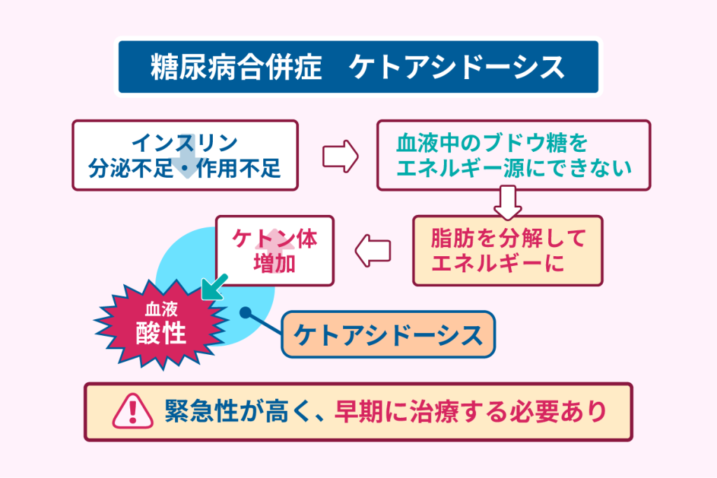 糖尿病合併症　ケトアシドーシス