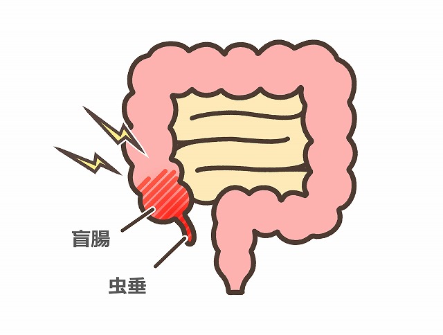 急性虫垂炎とは